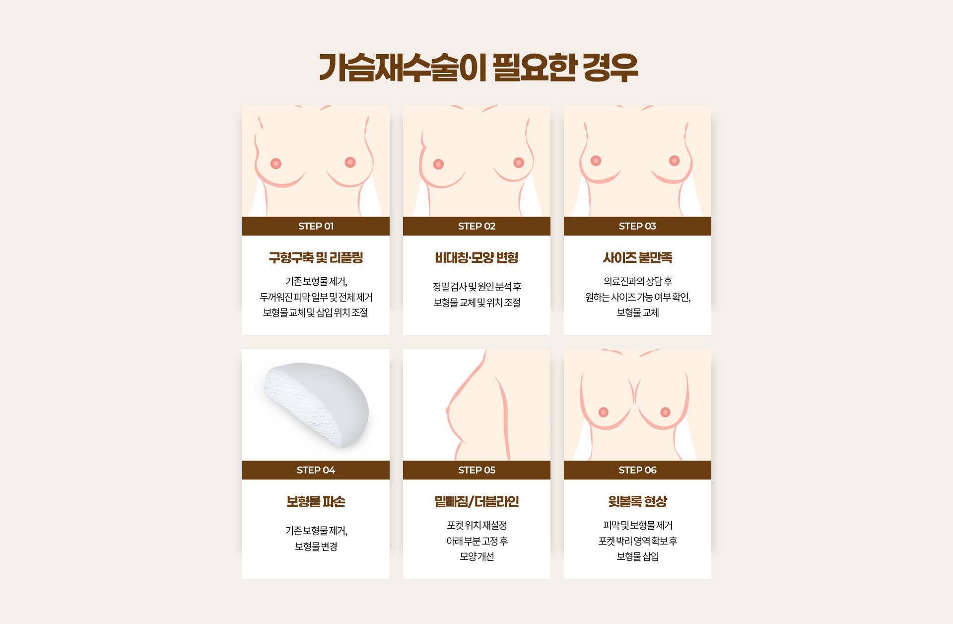 가슴재수술