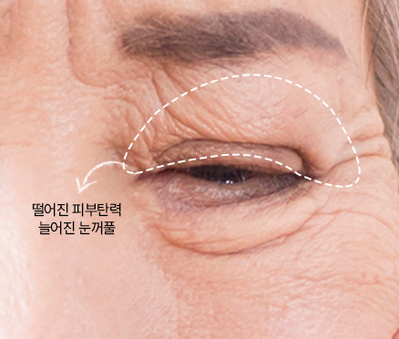 상안검성형