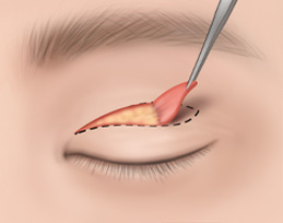 상안검성형