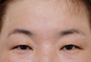 상안검성형