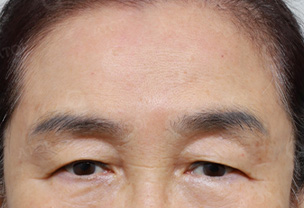 상안검성형