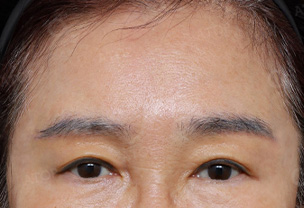 상안검성형