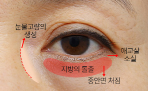 하안검성형