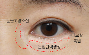 하안검성형