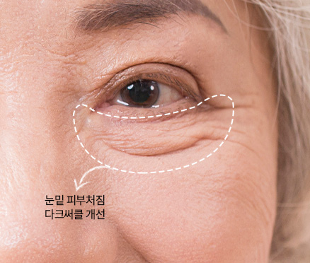 하안검성형