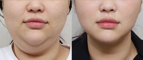 시그니처 윤곽패키지