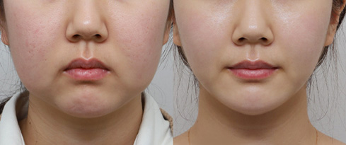 시그니처 윤곽패키지