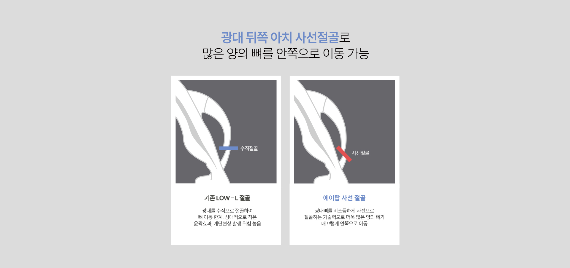 광대축소