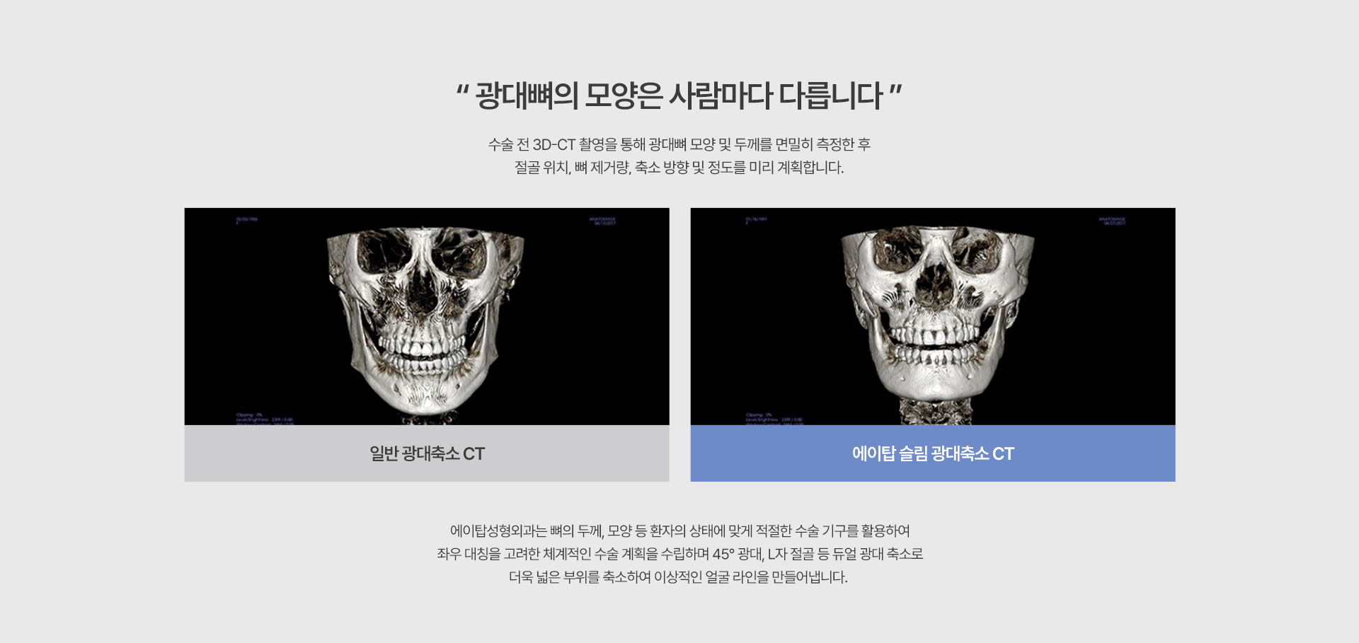 광대축소