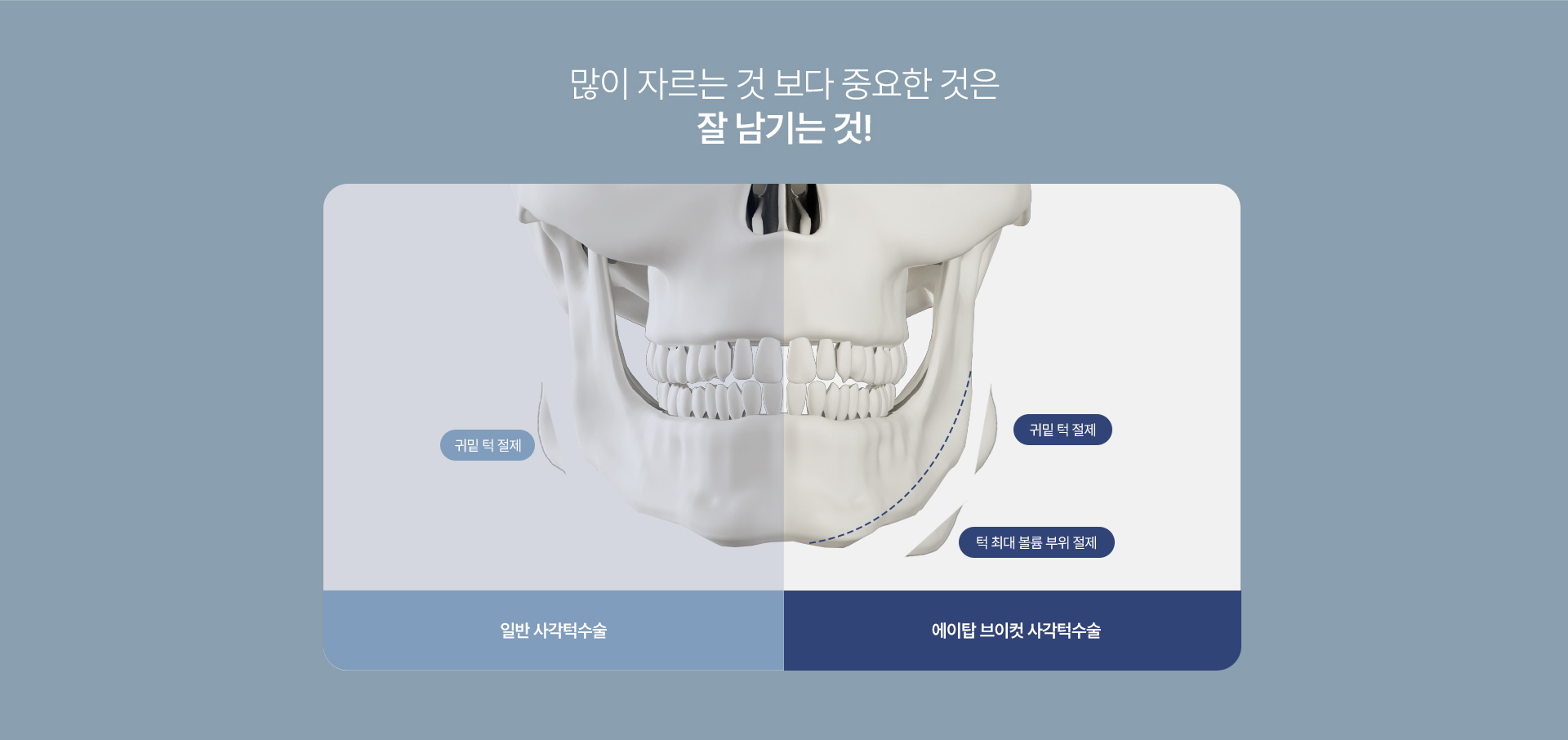 사각턱성형