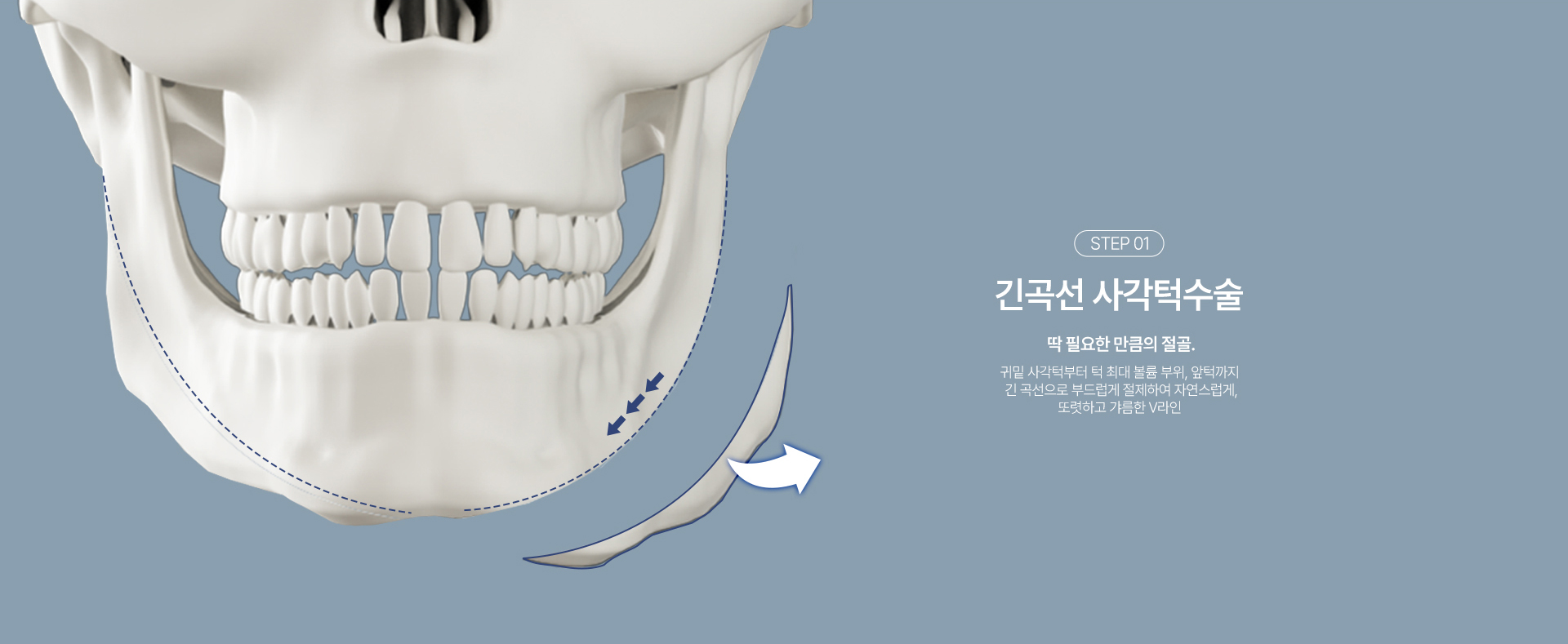 사각턱성형