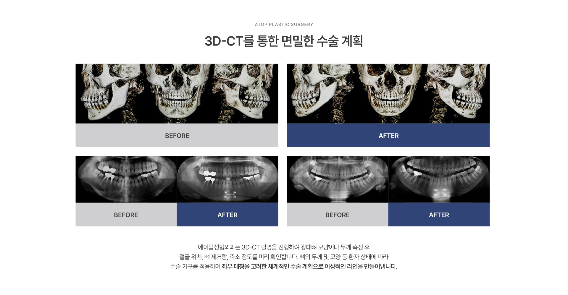 사각턱성형