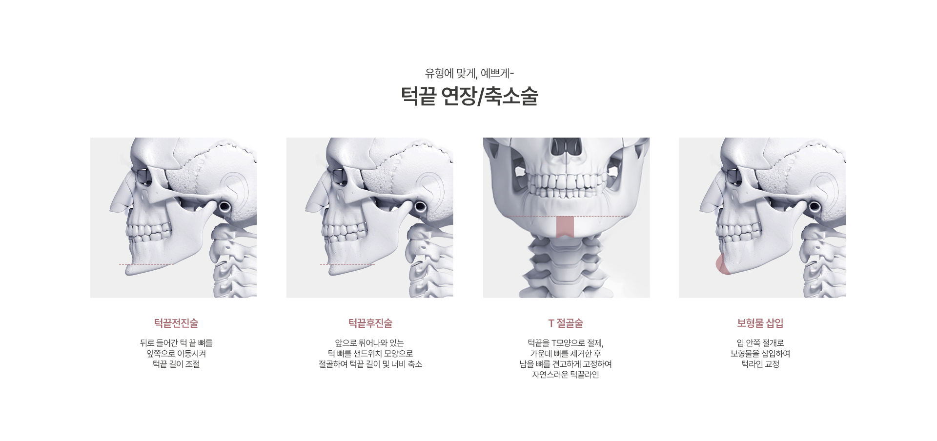 턱끝수술