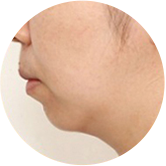턱끝수술