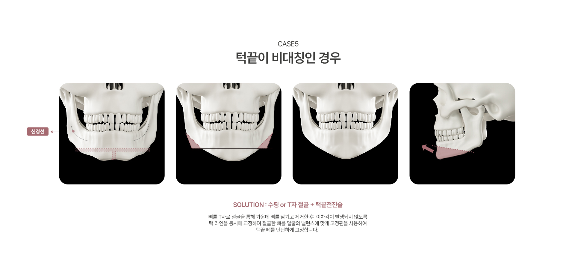 턱끝수술