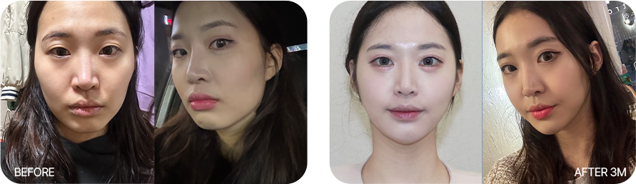 턱끝수술