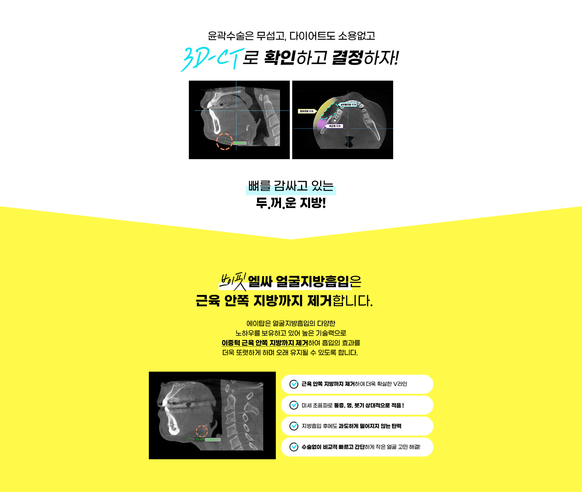 3D CT FIT 얼굴지방흡입