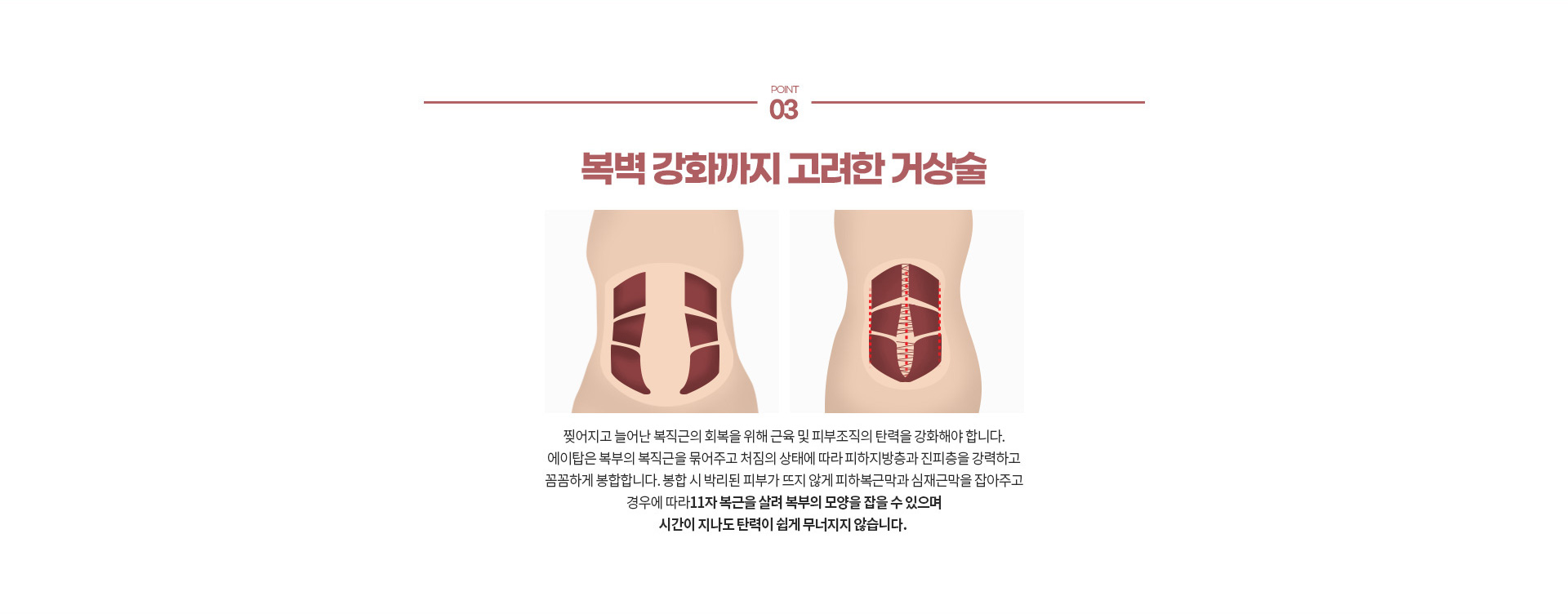 부위별 지방흡입