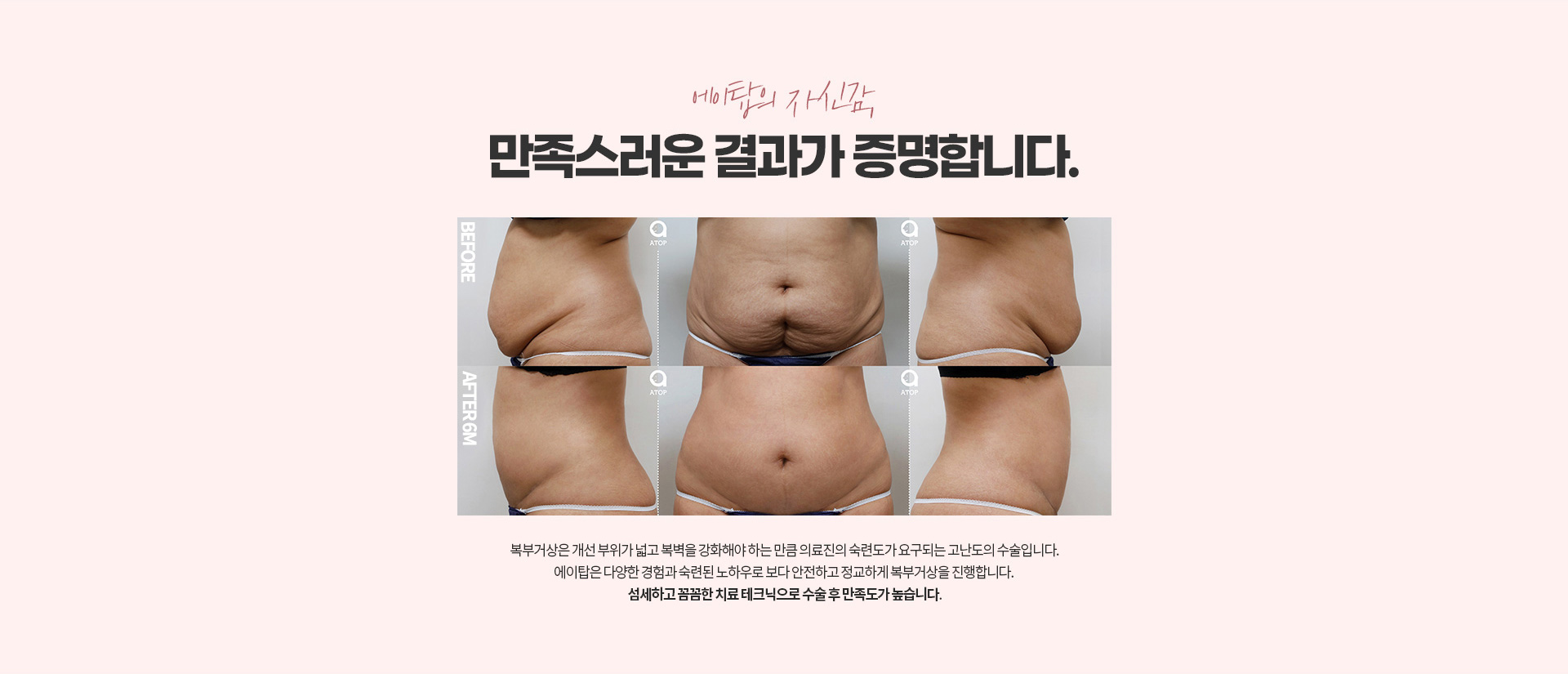 부위별 지방흡입