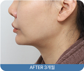 여우리프팅