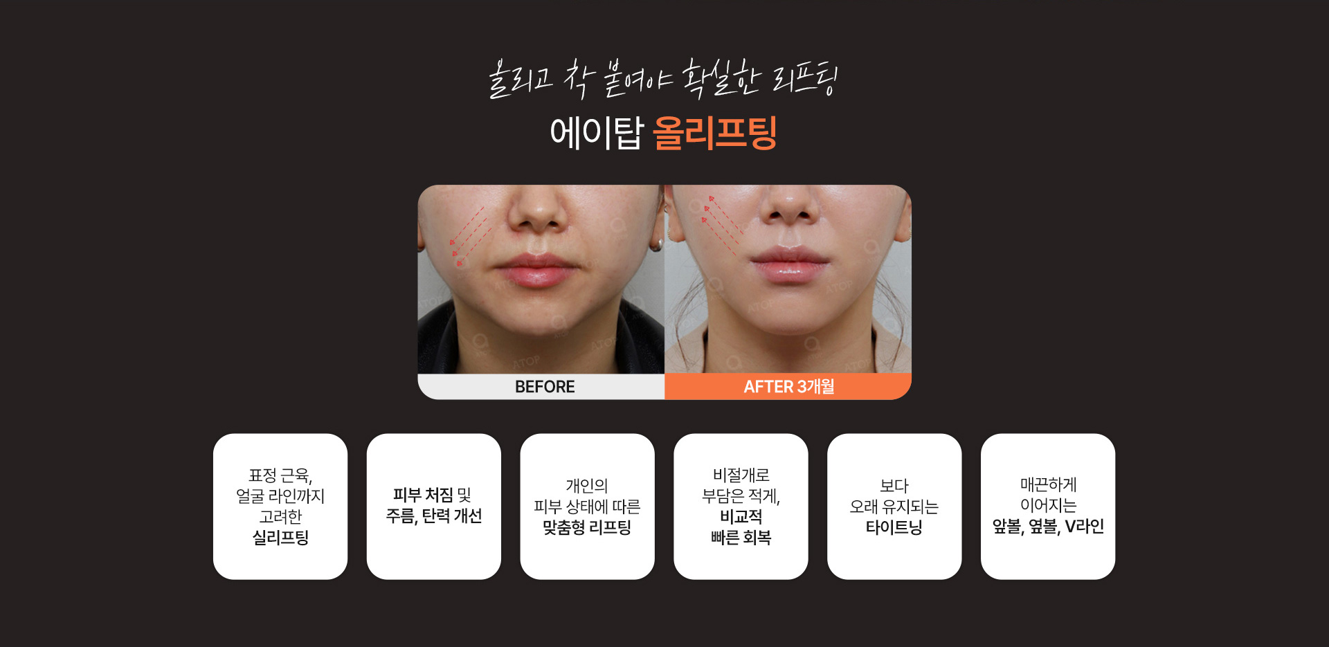 올리프팅
