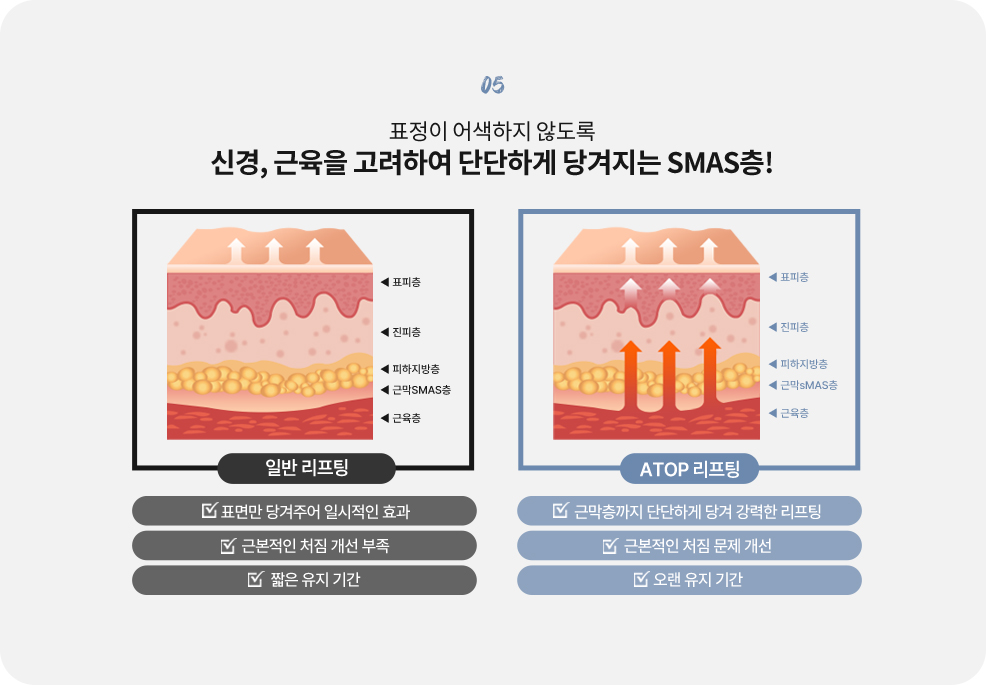 커스텀리프팅
