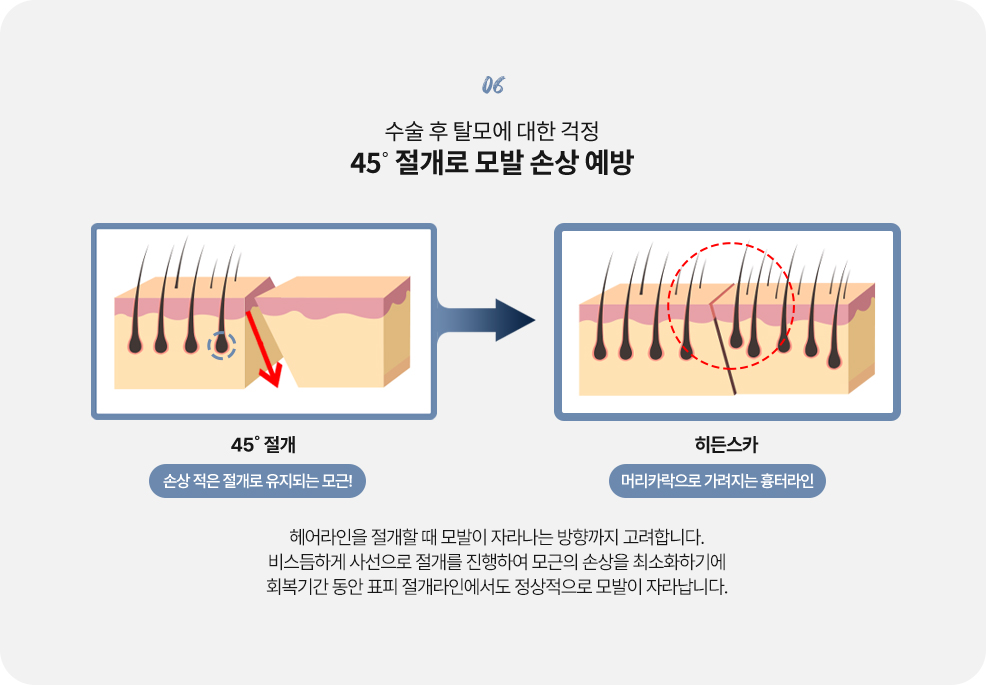 커스텀리프팅