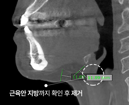 이중턱착붙리프팅