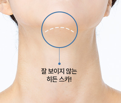 이중턱착붙리프팅