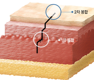 이중턱착붙리프팅