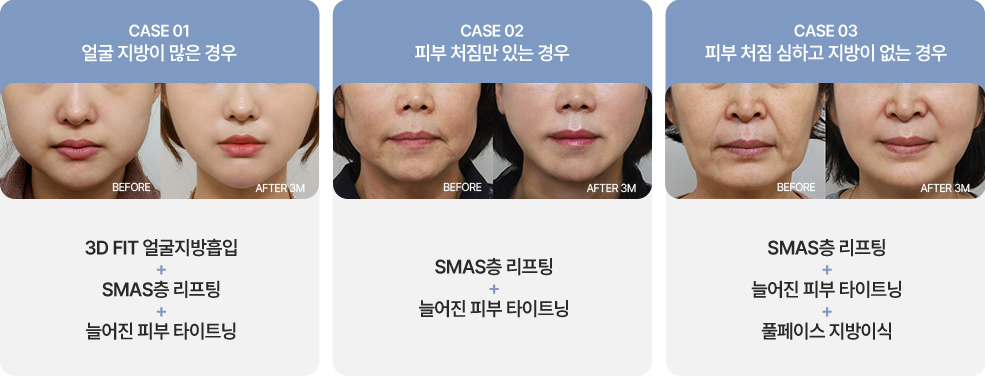 심술보리프팅