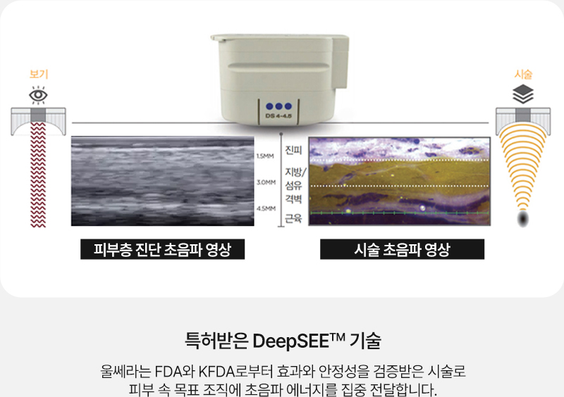 울쎄라리프팅