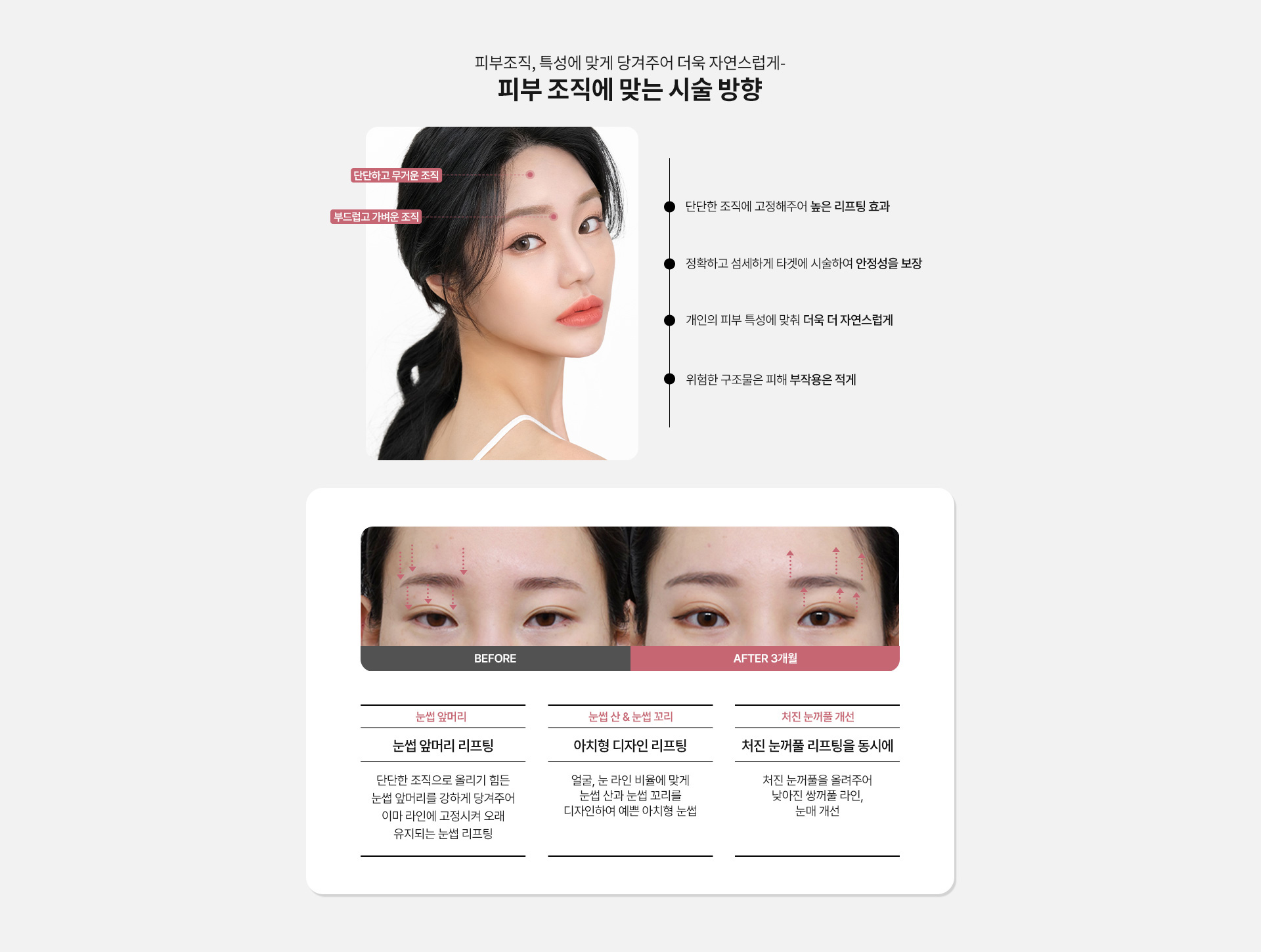 눈썹거상리프팅