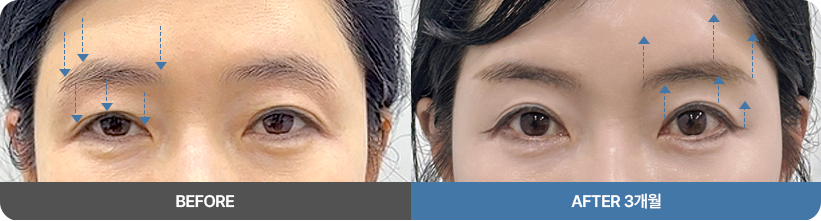 눈썹거상리프팅