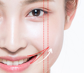 입꼬리성형