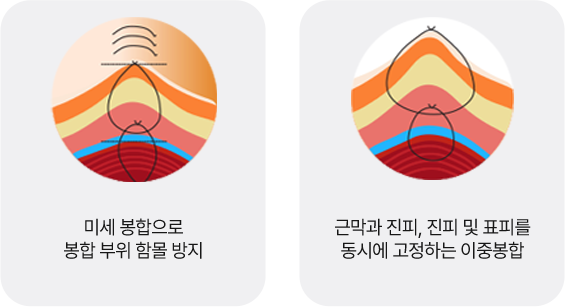 입꼭지성형