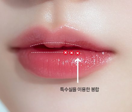 입술축소수술