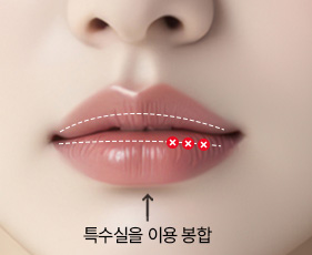 입술축소수술