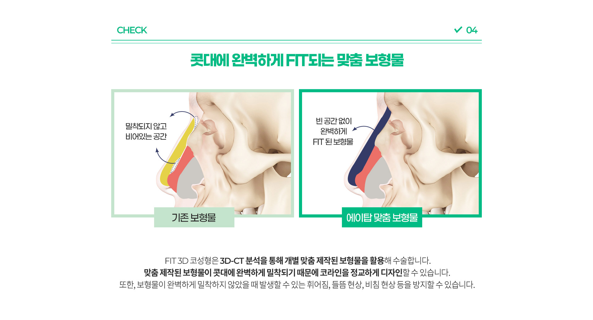 남자코성형