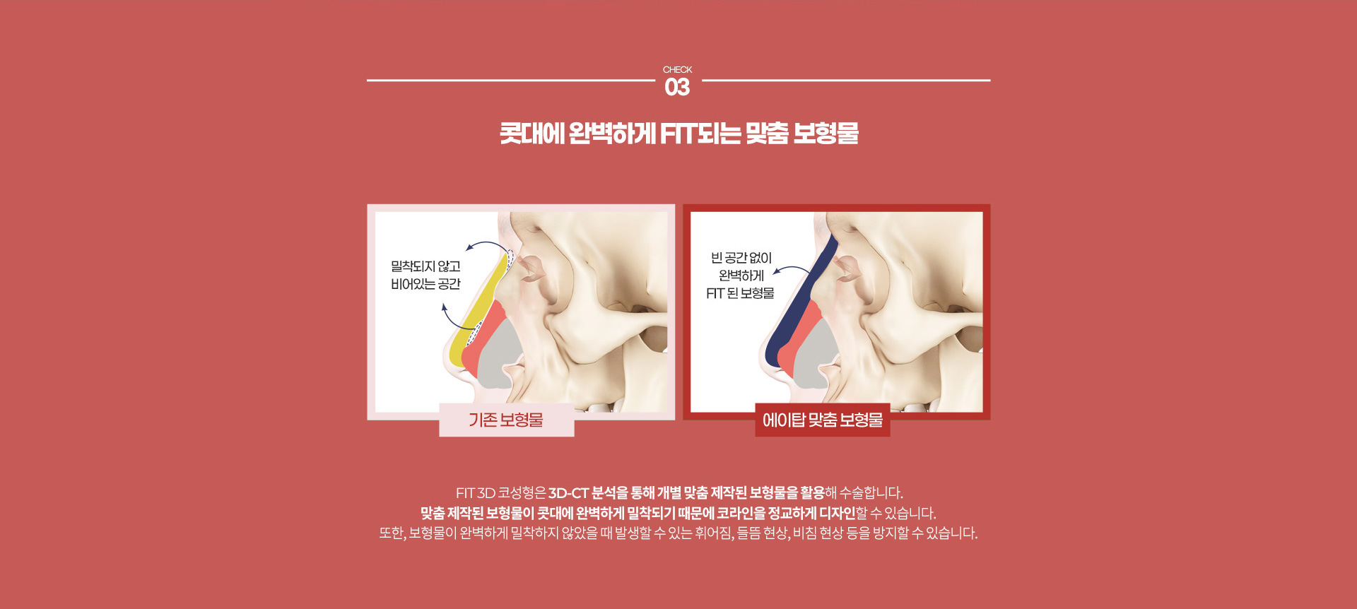 FIT 3D 코성형07