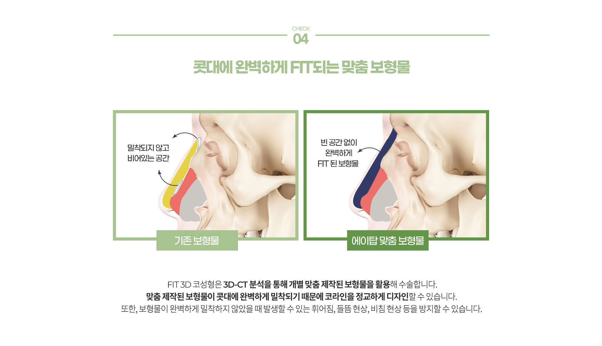 비염미용 코성형