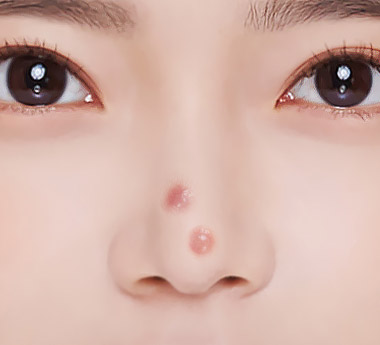 코재수술