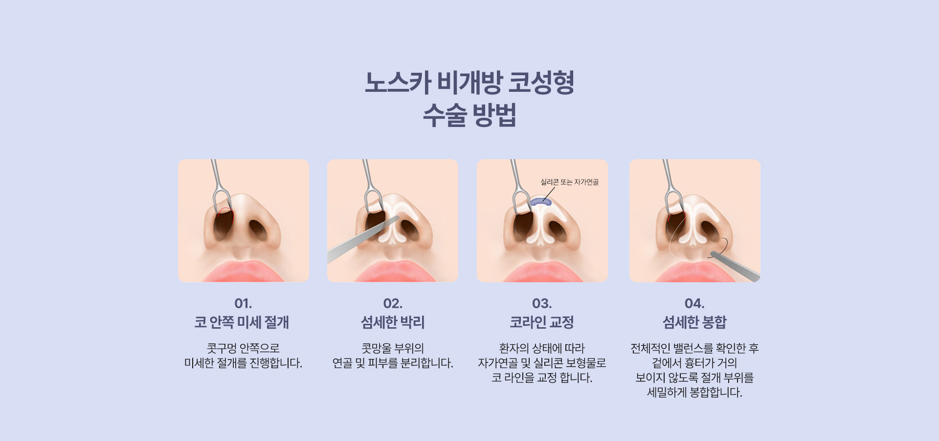 노스카 비개방 코성형
