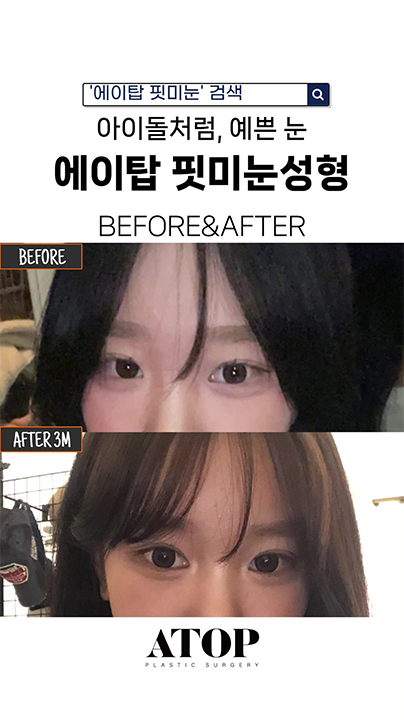 아이돌처럼, 예쁜 눈 에이탑 핏미눈성형 BEFORE&AFTER