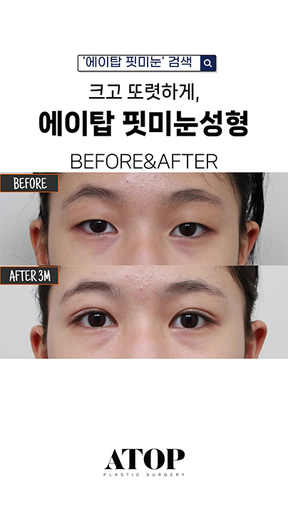 크고 또렷하게, 에이탑성형외과 핏미눈성형 BEFORE&AFTER