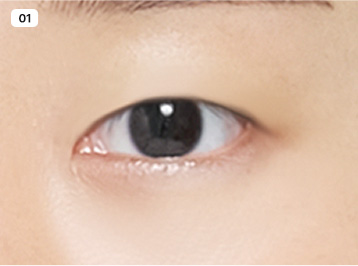 에이탑성형외과 핏미 자연유착 수술방법 이미지