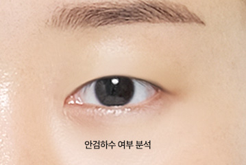 에이탑성형외과 눈성형 기술력 안검하수 여부 분석 이미지
