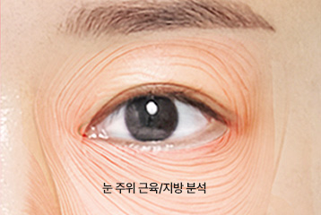 에이탑성형외과 눈성형 기술력 눈 주위 근육/지방 분석 이미지