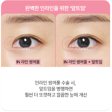 에이탑성형외과 완벽한 인라인을 위한 ‘앞트임’