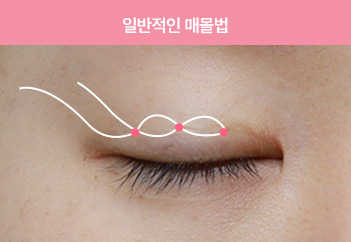 에이탑성형외과 일반적인 매몰법 이미지